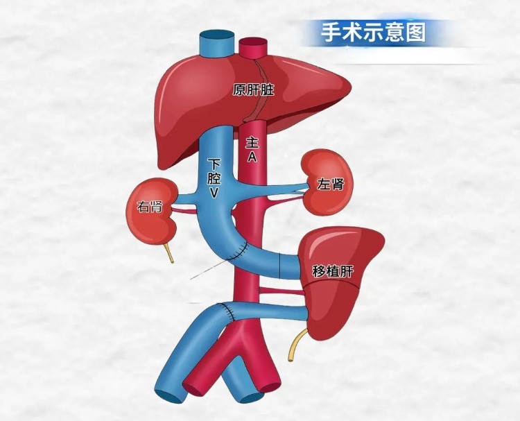 美国已率先成功将基因编辑猪的心脏