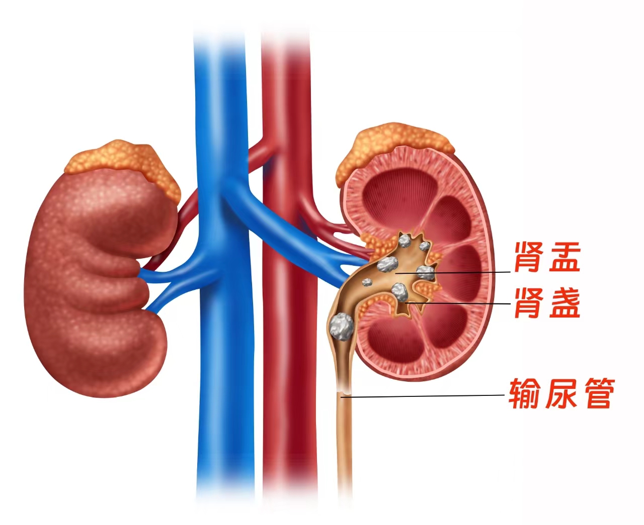 5岁女孩肾脏,输尿管多发结石!医生双镜联合取石